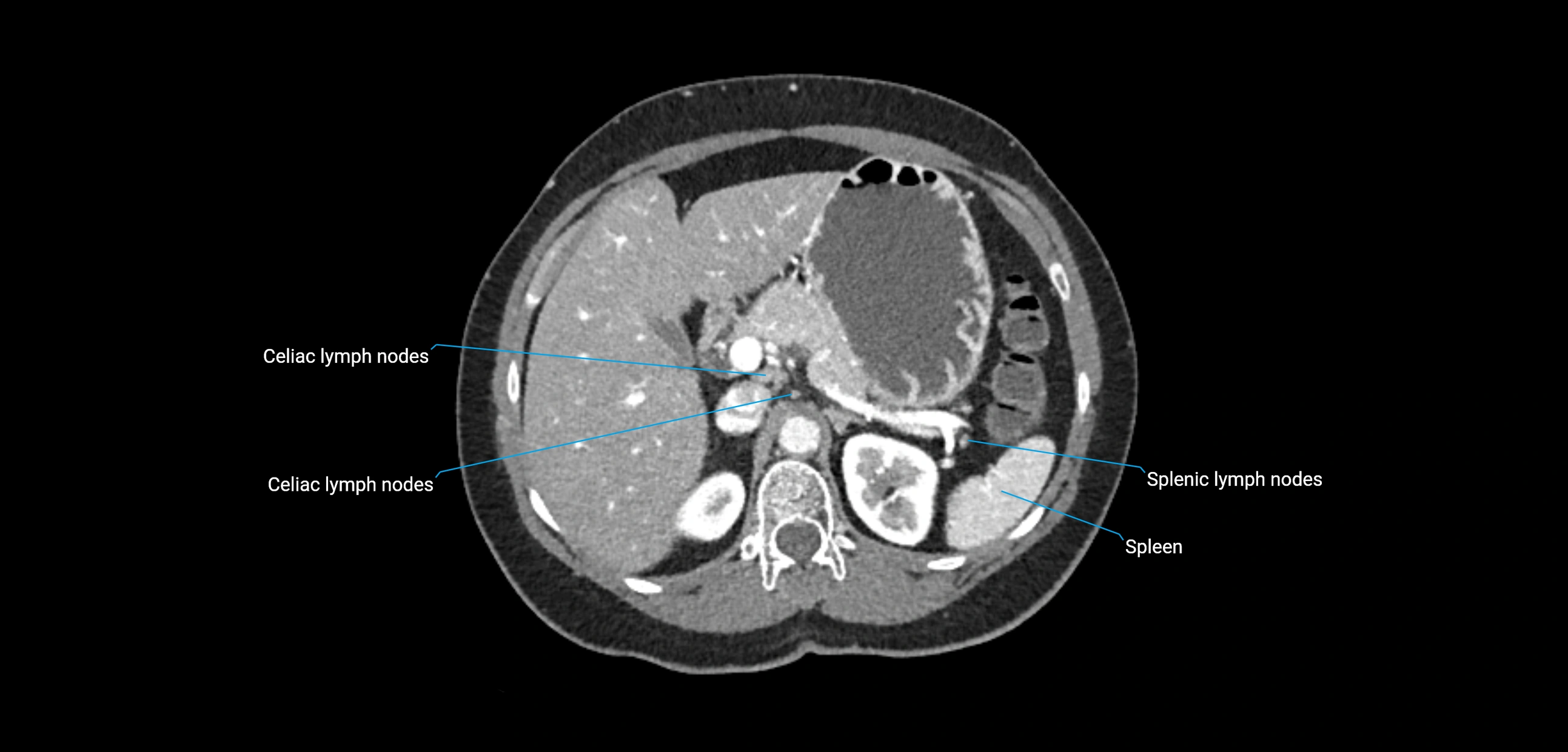 CT ct abdominal lymph nodes  axial cross sectional anatomy  enchanced radiology image -img-00002-00141.webp